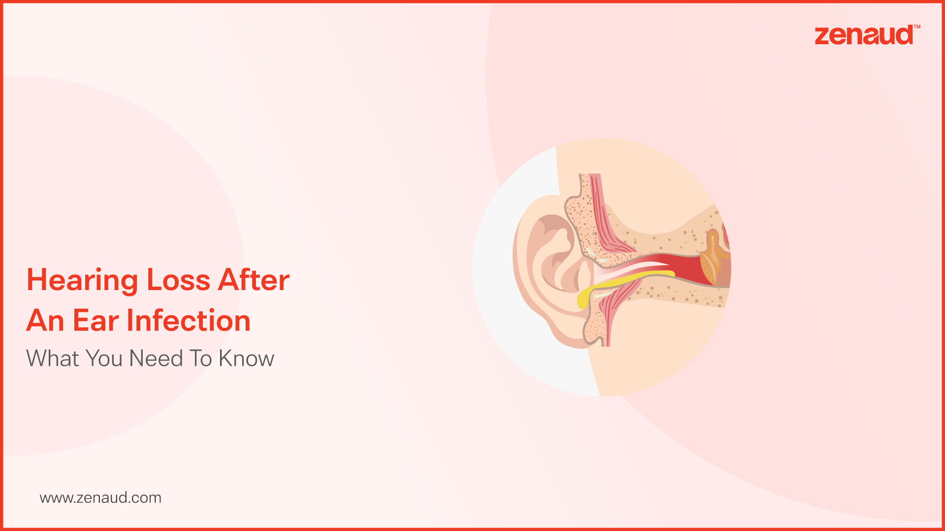 Hearing Loss After an Ear Infection