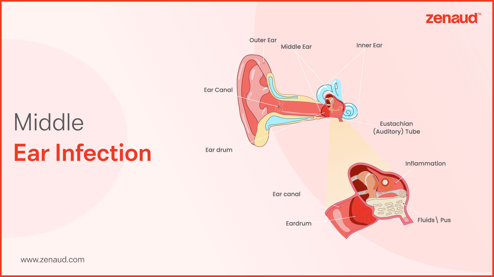 Middle Ear Infection