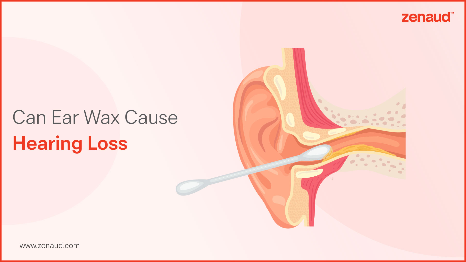 Can Ear Wax Cause Hearing Loss