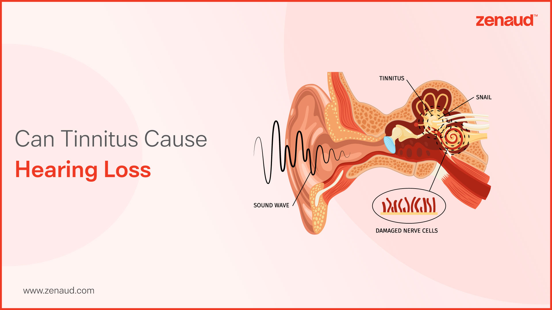 Can Tinnitus Cause Hearing Loss?
